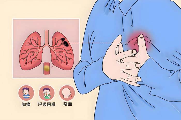 医疗动态丨多学科协作（MDT）打赢生命保卫战，微创术后肺栓塞患者转危为安